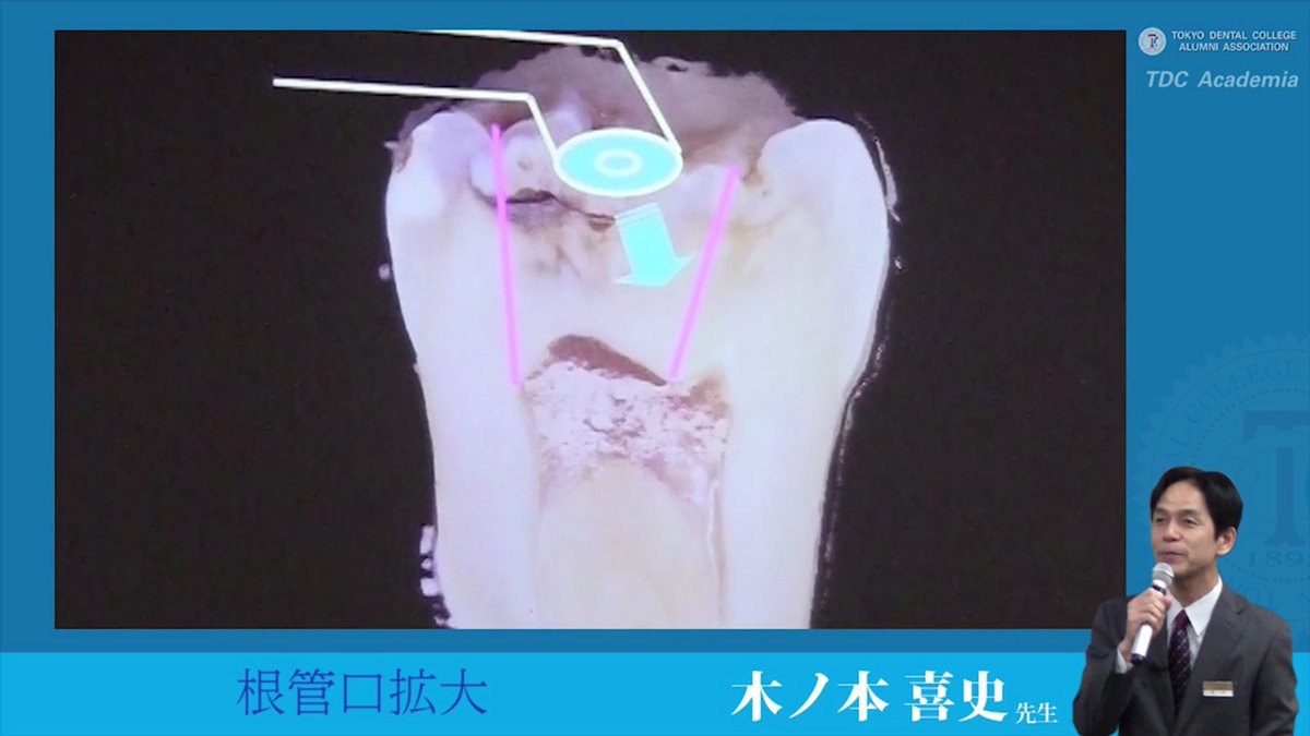 endodontics_03