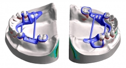 partial_denture_prosthodontology_03