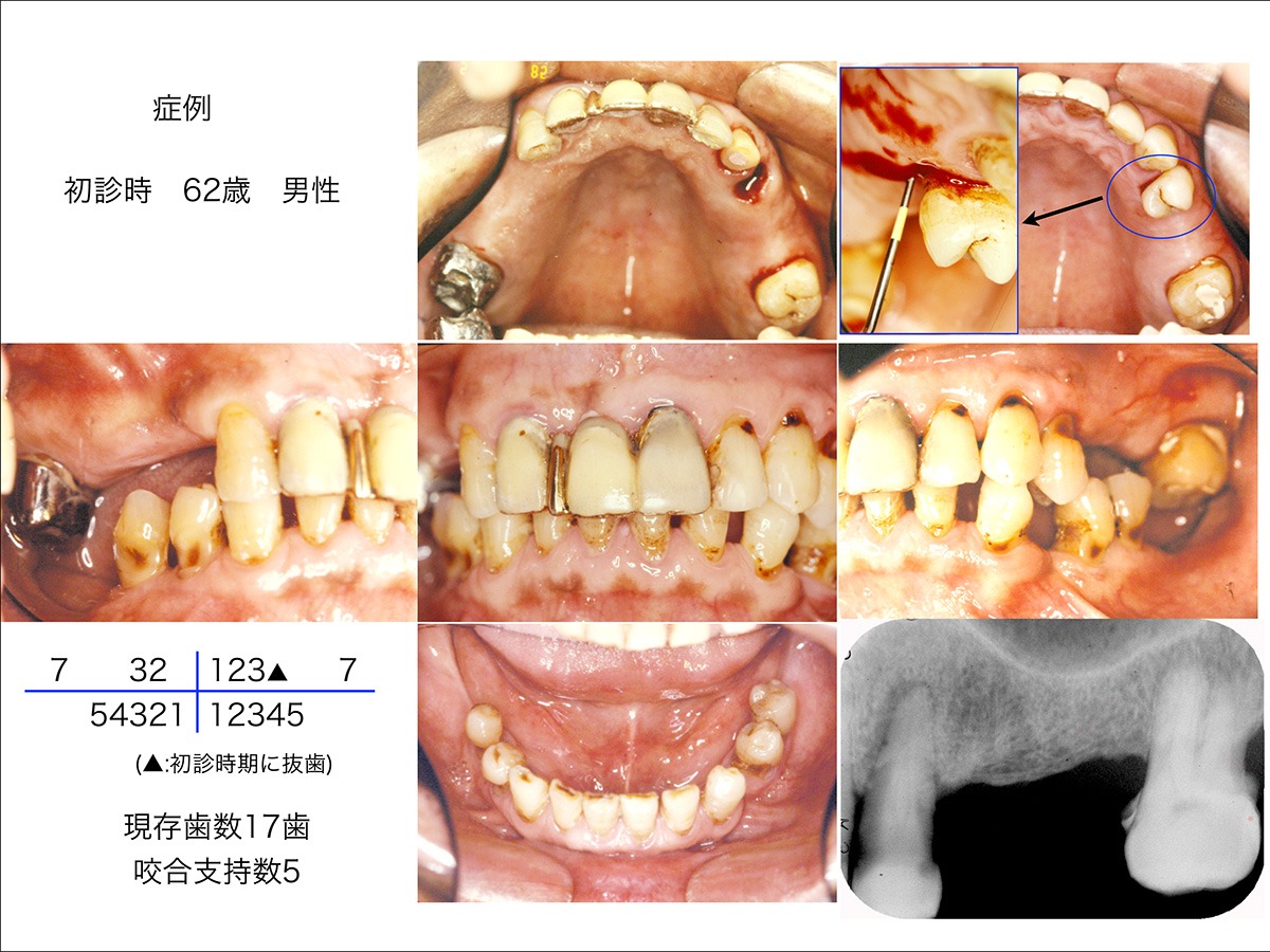 私の臨床ノート「欠損歯列をどう見るようになったか」（その３