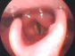 429_oral_health_dysphagia_05