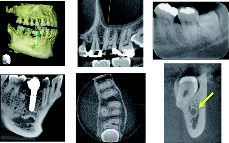 2018 TDCアカデミア 臨床セミナー／画像診断セミナー　デンタル、パノラマX線画像とコーンビームCTの読影（2017年5月20日（日））　講師：後藤　多津子（東京歯科大学　歯科放射線学講座　主任教授）