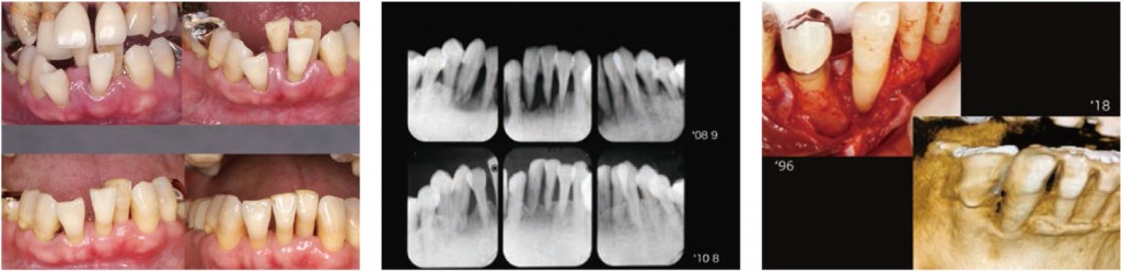 2019 TDCアカデミア 臨床セミナー／歯周基本治療セミナー「ハンドスケーラー VS 超音波スケーラー」〜「最良」の歯周基本治療！！〜（2019年7月21日（日）・講師：牧野　明、大野純一）